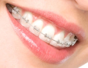 Керамические брекеты